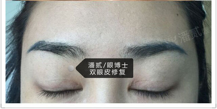 原来双眼皮不好看有必要继续割吗,割双眼皮是不是越修复越难看