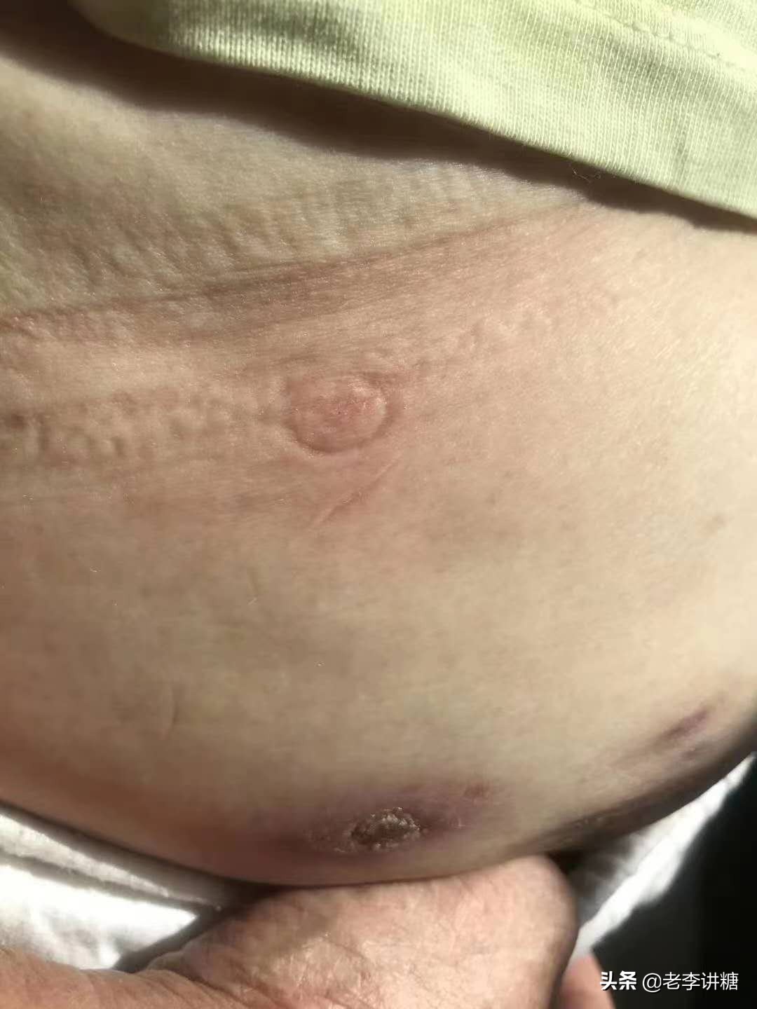 糖尿病无针胰岛素注射器能用多久,糖尿病胰岛素无针注射器价格表