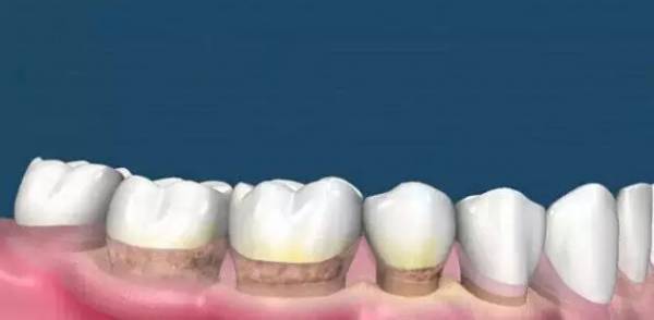 洗牙到底怎么洗好,洗牙洗的不干净