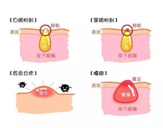 疮的原因和治疗方法,疮什么原因引起的