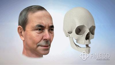 种植牙是什么种植技术,种植牙一般要怎么种植的