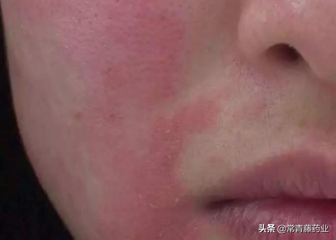 面部皮炎用什么药最有效,面部皮炎治疗中可以用什么修复