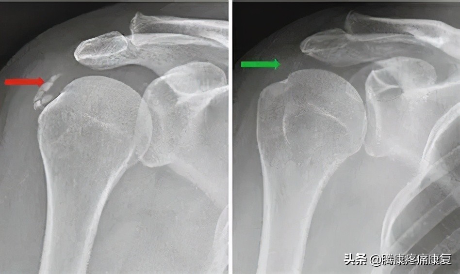 肩关节急性钙化性肌腱炎