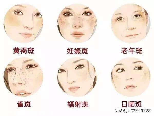 斑点橡皮擦真的能一秒祛斑吗,橡皮擦祛斑超皮秒用法