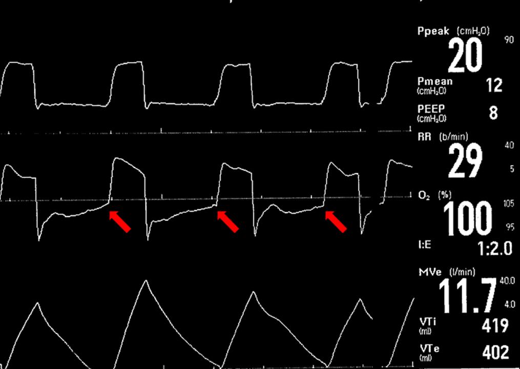 新冠肺炎机械通气系列课程(讲义)-阻塞性肺病的机械通气