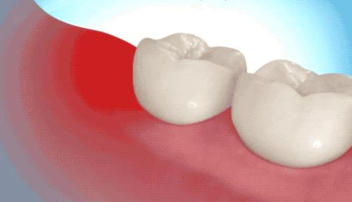 拔了一颗智齿花了1300元贵吗,拔个智齿花了800