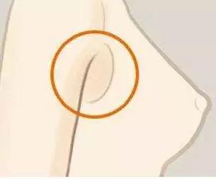 副乳是癌前兆？9102年了，别再被忽悠了