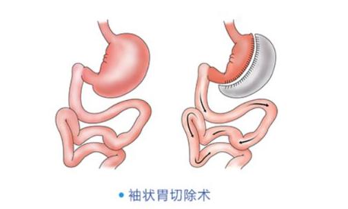 杨天真切胃后瘦了吗,杨天真做切胃手术