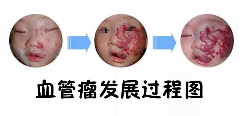 宝宝有一块红胎记是血管瘤吗,新生儿红胎记正常吗