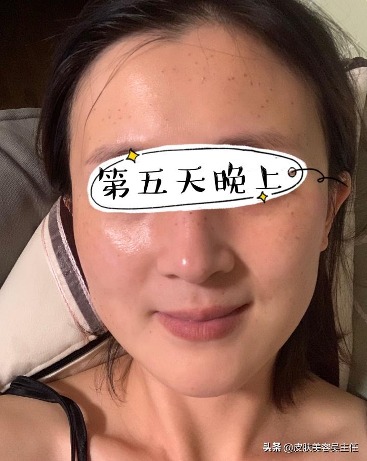 蜂巢皮秒英诺小棕瓶,脸上有斑的可以用英诺小棕瓶吗