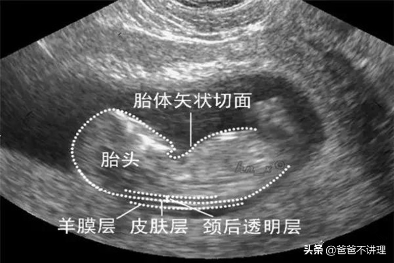 孕三月检查nt有点厚怎么办,产检nt高是什么原因导致的