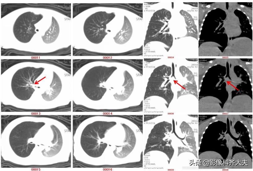 小儿气管镜怎么检查,小儿ct检查全过程视频