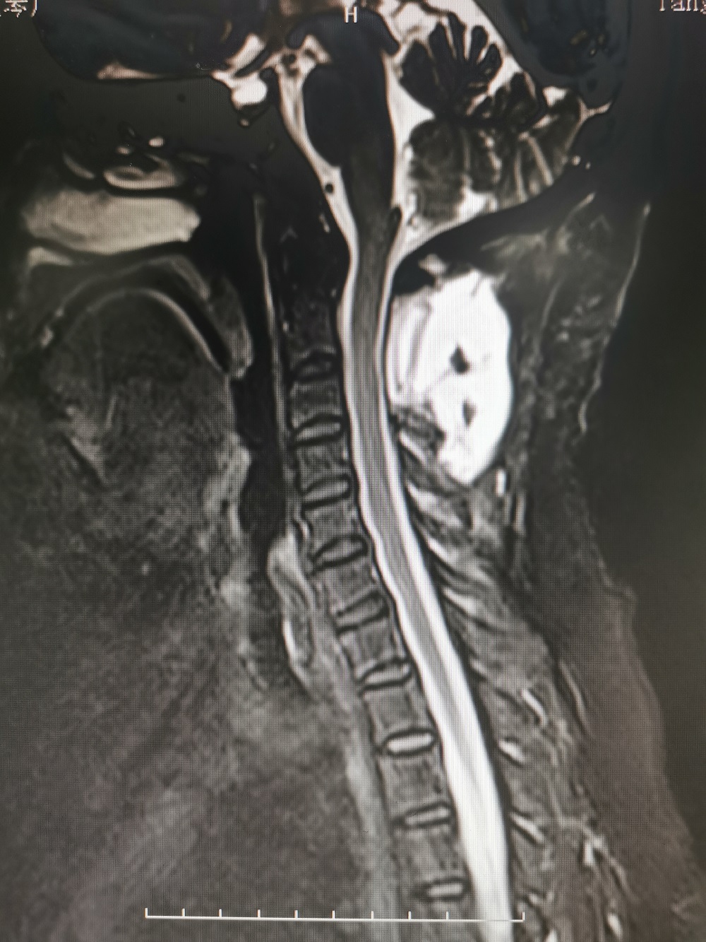 无缘无故手麻木伸不直,无缘无故两手发麻是什么情况