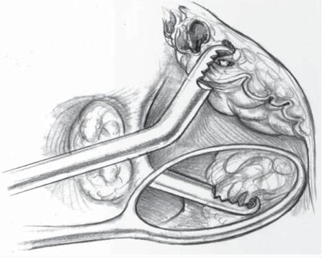 扁桃体切不切,扁桃体手术是切一半还是全切