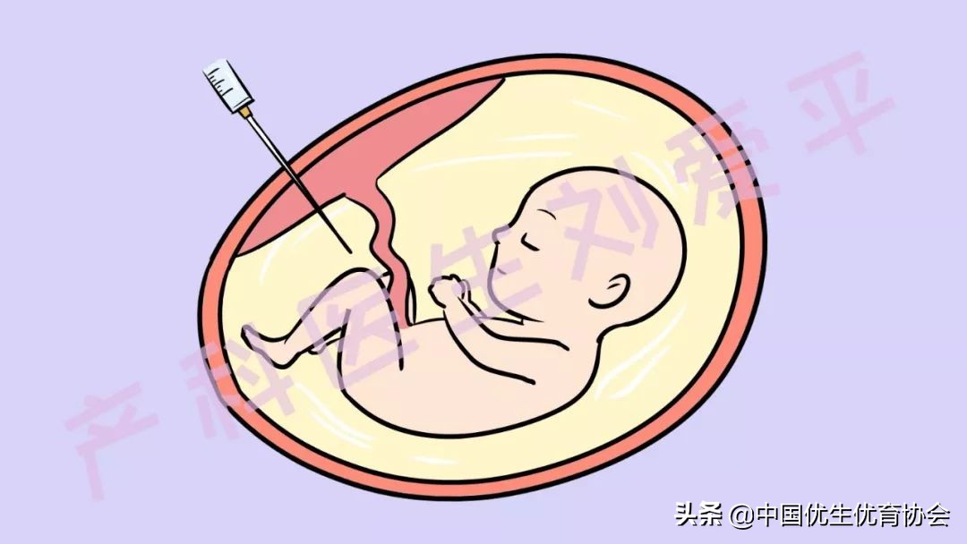 羊水穿刺孕妈,做羊水穿刺之后孕妈呼吸急促