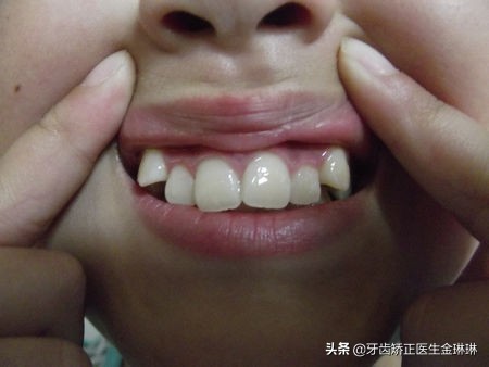 有老虎牙的人会是怎样的,有老虎牙怎么办