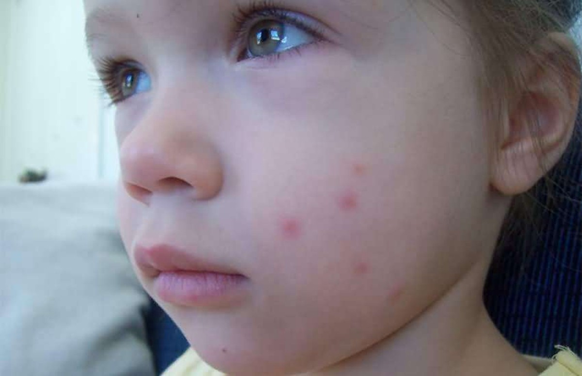 蚊子咬了宝宝能涂花露水吗,蚊子咬了宝宝的手可以涂花露水吗