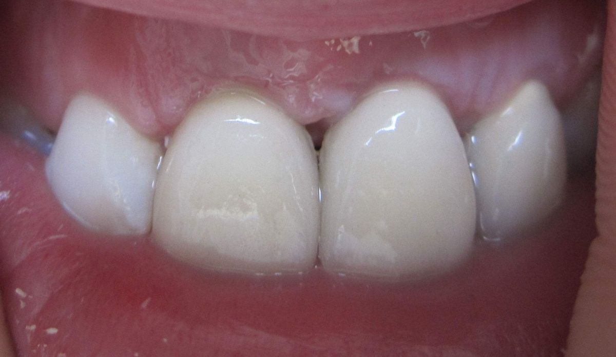 矫正牙齿为什么牙齿有牙缝了,12岁儿童门牙中间有缝隙怎么矫正