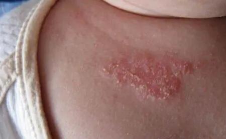 湿疹宝宝用的身体乳推荐,宝宝湿疹推荐产品