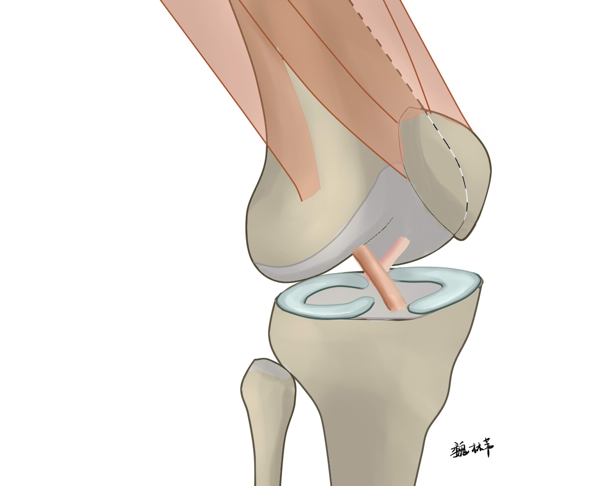 半月板缝合有必要切除滑膜吗,半月板缝合和半月板切除哪个严重