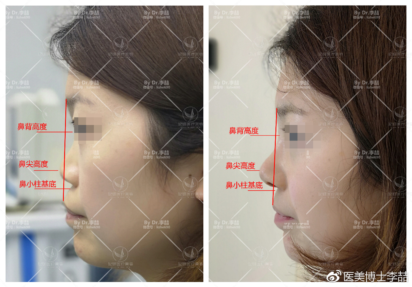 先天性鼻缺损和畸形的修复,先天性鼻中隔缺损