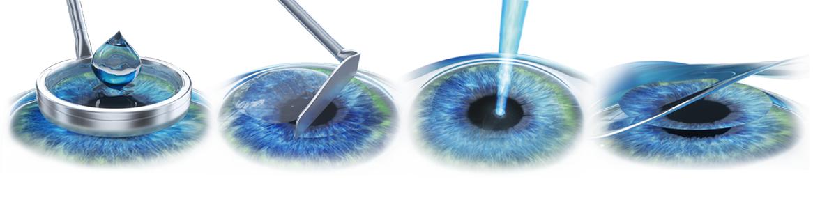 近视眼激光手术后20年后的后遗症,权威讲解近视眼手术的利弊