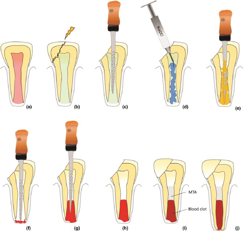 牙髓坏死了还能救回来吗？医生：这个技术很多人不知道
