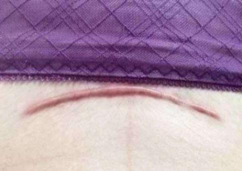 剖腹产难看的疤痕教你轻松美化,剖腹产疤痕恢复经历真实讲述