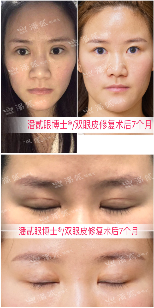 广州双眼皮凹陷修复视频,小切口双眼皮肉条修复