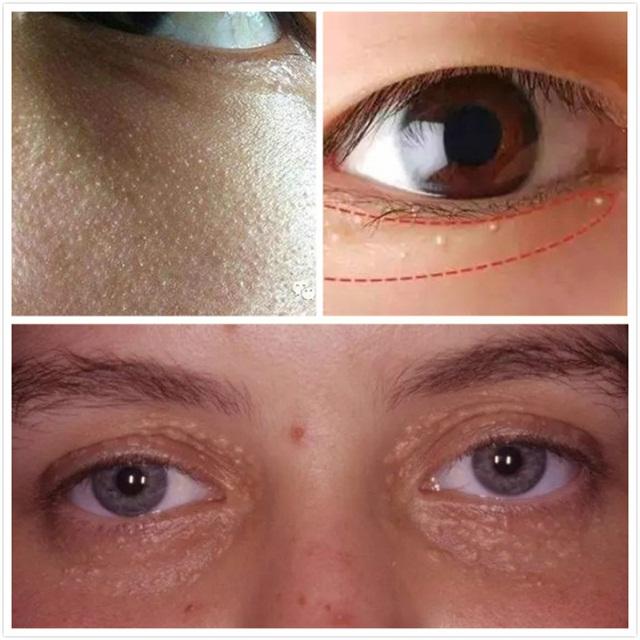 脸上长脂肪粒3个小妙招去除,脸上长了脂肪粒怎么消掉