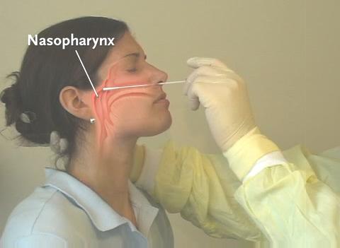 儿童流感为什么头疼,流感季节为什么孩子反复高热