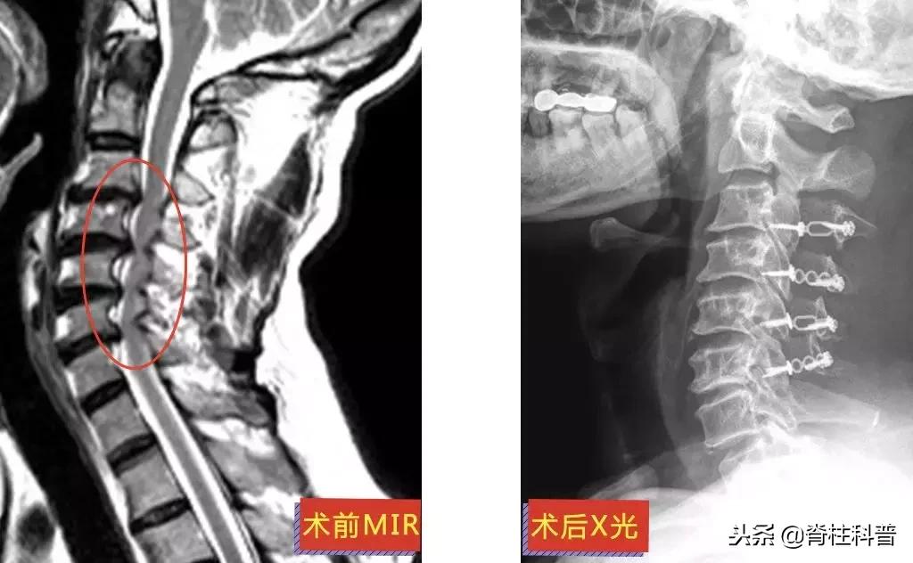 颈椎病治疗的分享,关于颈椎病通俗易懂的科普