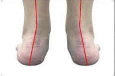 胫骨平台塌陷2-3mm的治疗方法,有足弓但是是扁平足怎么办