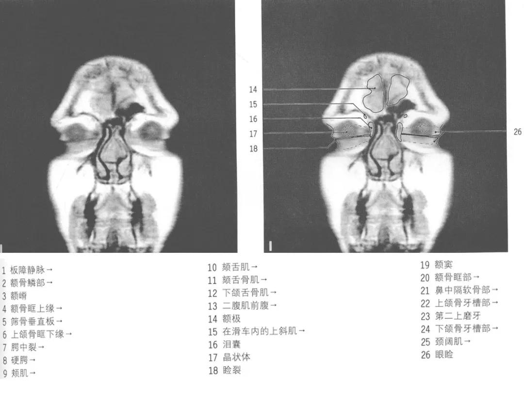 颅脑冠状状切面解剖图,颅脑mr解剖结构图