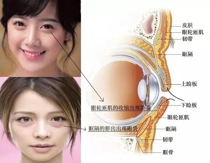 怎么区分眼袋和卧蚕图片女人,眼袋泪沟卧蚕区分图