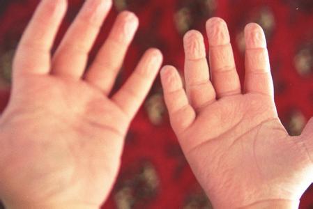 春季手指脱皮是怎么回事,春季儿童手指肚脱皮怎么治