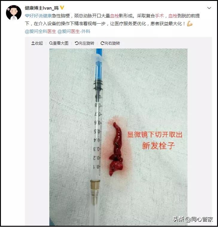 是不是有的血栓也不要过度治疗,能彻底治疗血栓吗