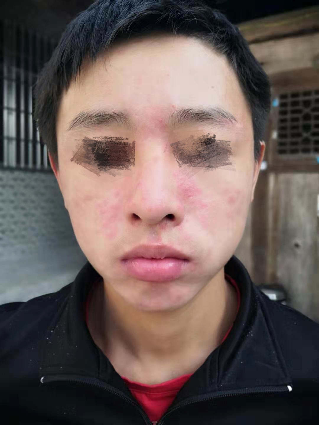 16岁男孩子脸部痘痘严重,16岁男孩身上长痤疮怎么治疗