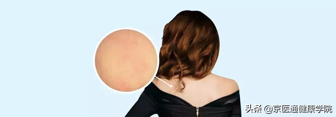 顽固湿疹痘痘,痘痘湿疹肌肤怎么改善