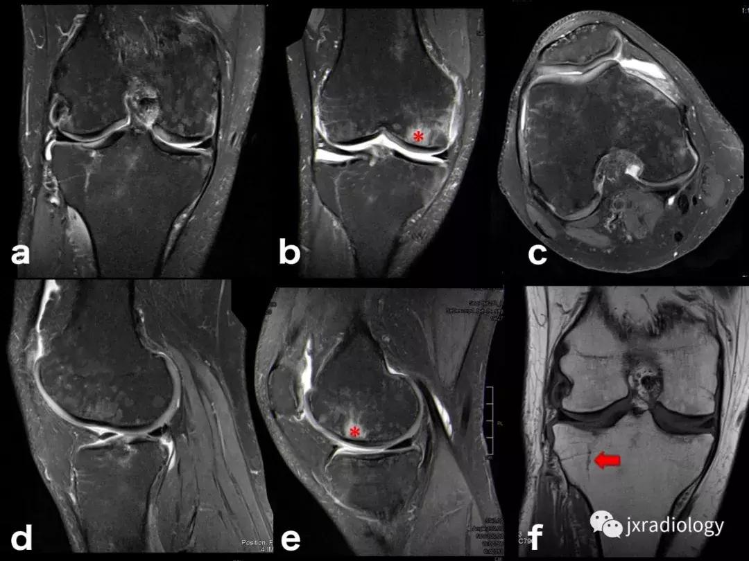 磁共振天天诊断骨髓水肿，但您知道原因吗？