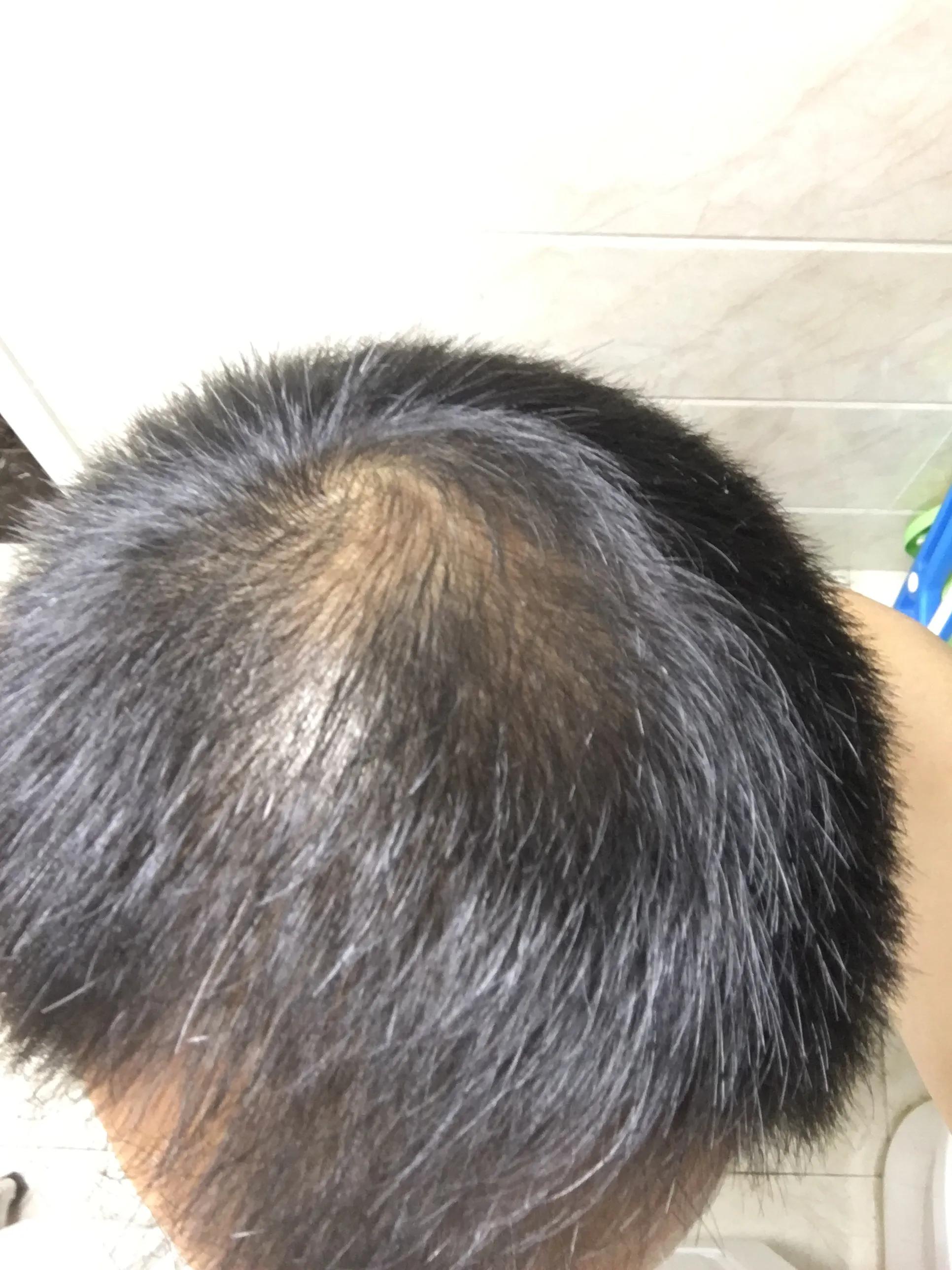 有谁治好了脂溢性脱发,脂溢性脱发用什么洗头