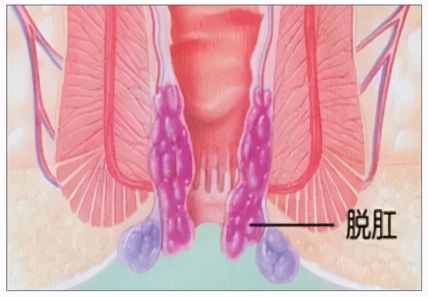 脱肛不及时治疗后果,脱肛长期不治危害大吗