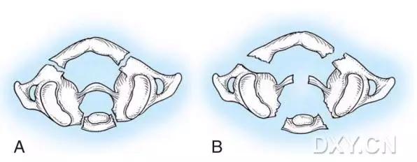 几种严重骨折医学名称,常见的骨折有哪些名称