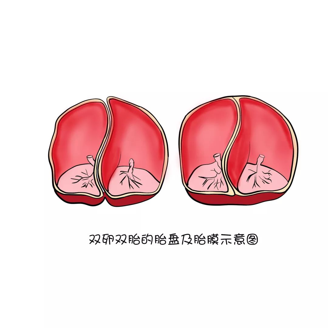 双胞胎孕妇大揭秘,双胞胎的深度解析