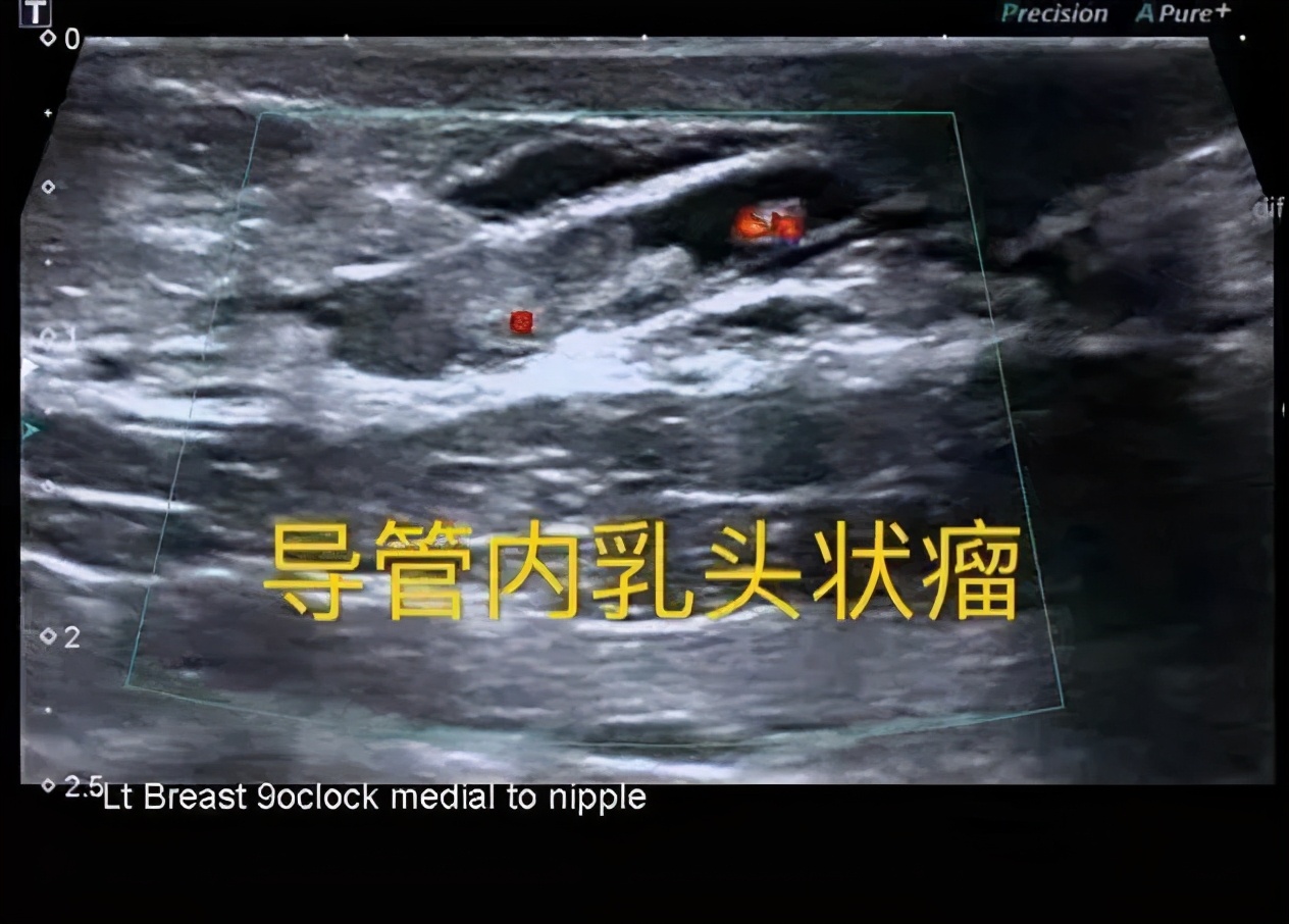 乳房出水是乳腺癌吗,乳腺癌乳头流水