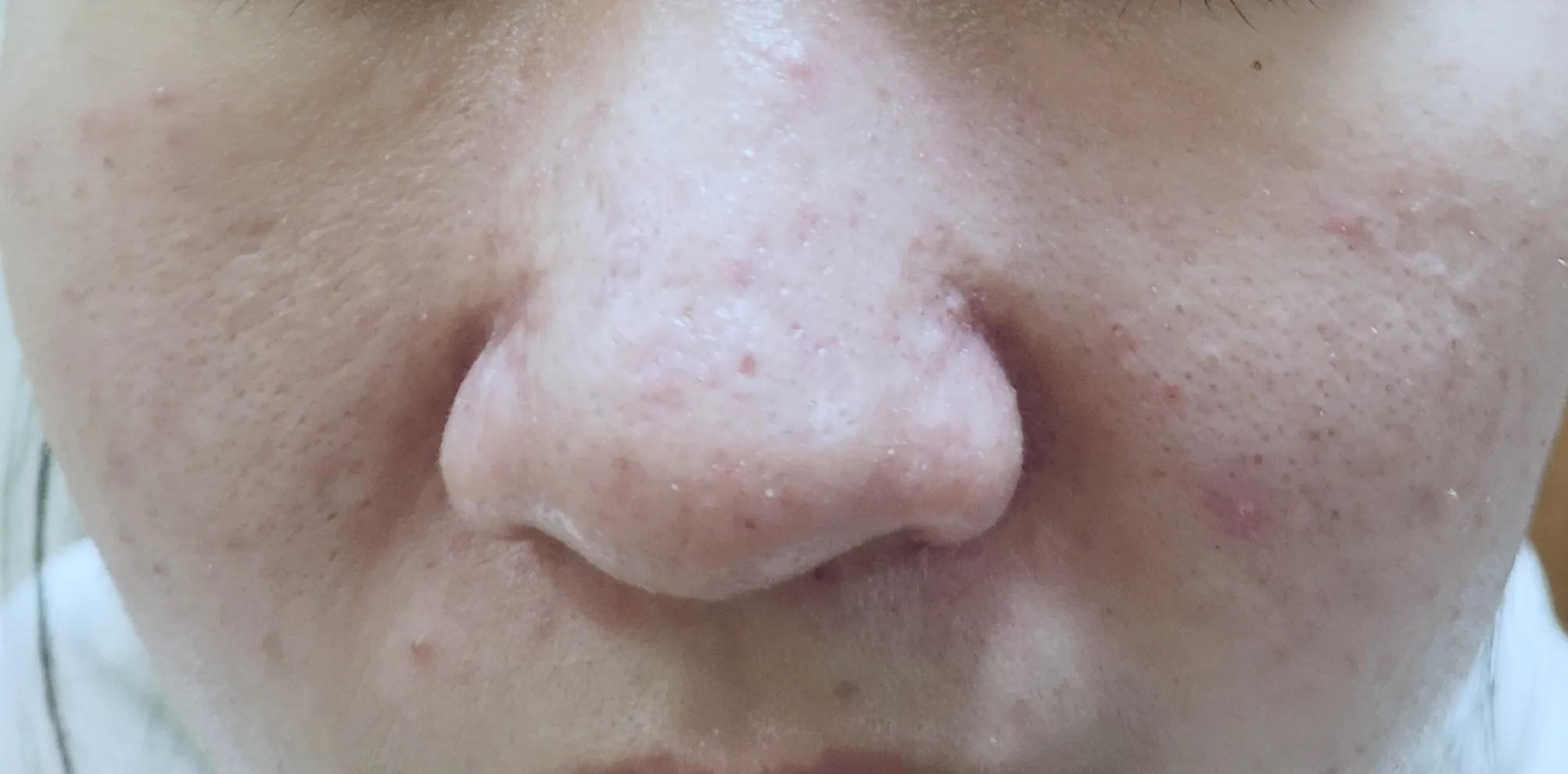 快来月经了下巴长痘痘是什么原因,经期下巴长痘痘是什么原因引起的