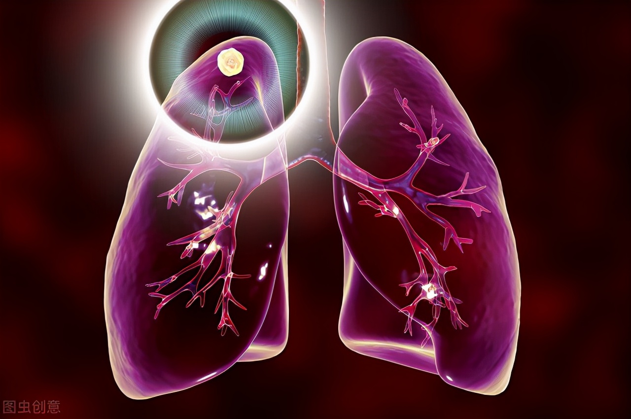 肺部多发小结节可以消除吗,肺部有小结节怎样调理好呢