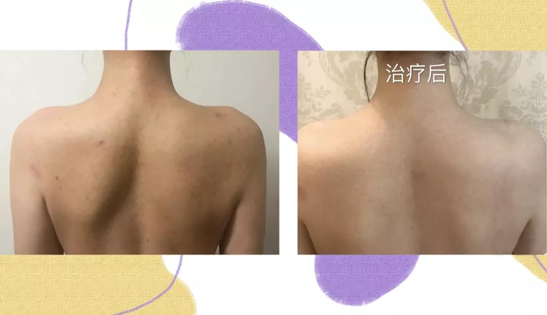 大痘印适合做什么医美,医美做什么可以去除痘坑