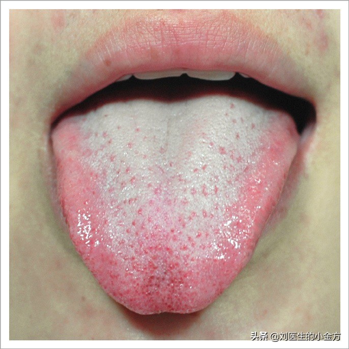 舌象图解大全中医舌诊,最全中医舌诊图谱来了
