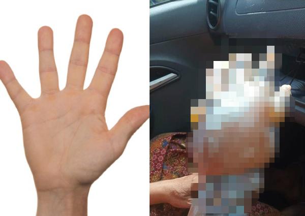 轻度烧伤用冷水冲洗后可涂抹牙膏,烧伤涂抹牙膏有用吗